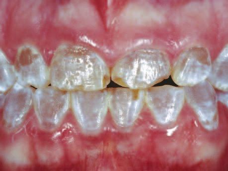 Clinical Restoration of teeth using lithium disilicate glass-ceramics in a patient with Dentinogenesis Imperfecta Daniel Edelhoff 1, Oliver Brix 2 and Josef Schweiger 1 Introduction The availability