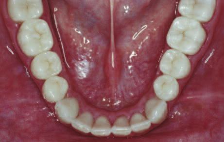 During the period up to the incorporation of the permanent crowns, chairside-fabricated temporaries were used.