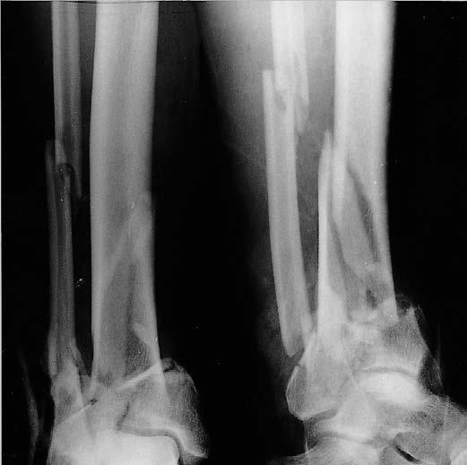 Distal tibial fracture Below left: 50-year-old man, impaction and compression of the right