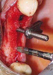 incision and blood collection with a sterile syringe for further bone graft; c) pilot drilling at the site of dental implantation with simultaneous ISL; d) 2.