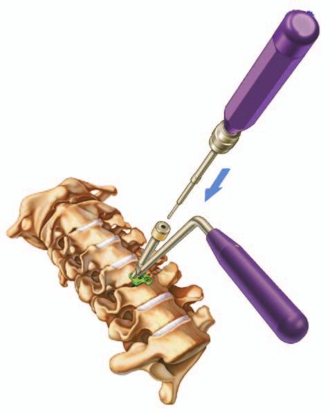 placement 15 cranial/caudal screw angulation