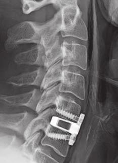 insertion End-plate sparing screw placement, with direct ACDF approach Post-operative