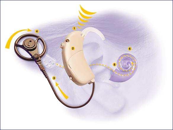 Who are cochlear implants for? Essential feature People with little or no hearing and little conductive component to the loss who receive little or no benefit from a hearing aid.