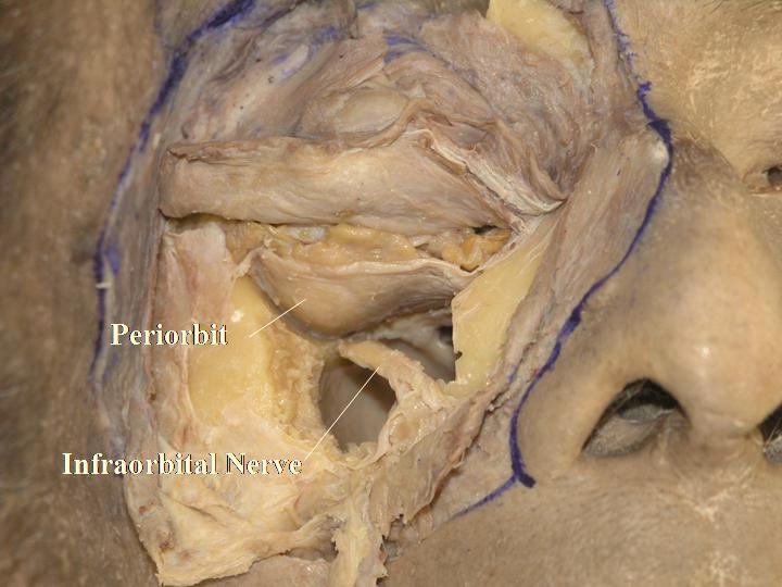 Eyelid and Orbital Dissection with New Anatomical Findings The Open Anatomy Journal, 2010, Volume 2 15 Fig. (3-9). The oblique course of the infraorbital nerve can be visualized. Fig. (3-12).