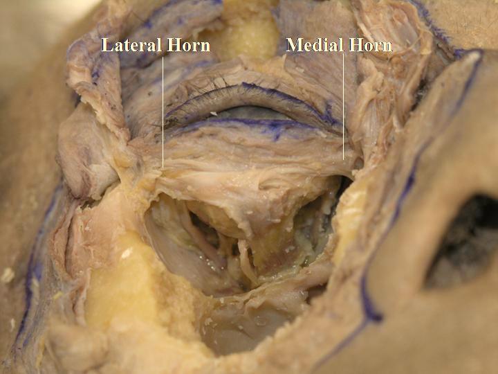 rim. Lockwood s ligament, corresponding to Whitnall s ligament in the upper eyelid, inserts onto Whitnall s tubercle in the lateral canthus and becomes part of the lateral retinaculum (which is