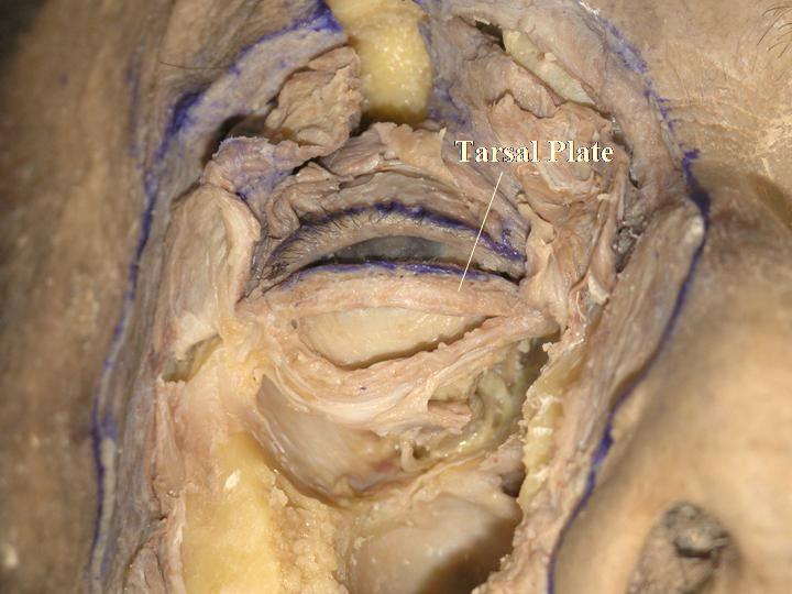 The pretarsal orbicularis oculi muscle (OOM) is continuous with the medial canthal tendon (MCT). Fig. (3-18). The lower tarsal plate is exposed. Its shape is usually rectangular.