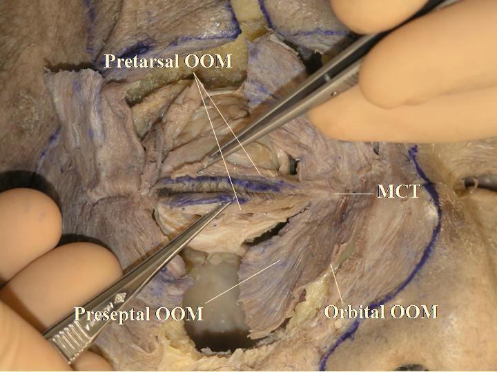 Dissections of the Conjunctival Fornix, Extraocular Muscle Insertions, and Medial and Lateral Canthi A. The relationship between the pretarsal OOM and the MCT is analysed again.