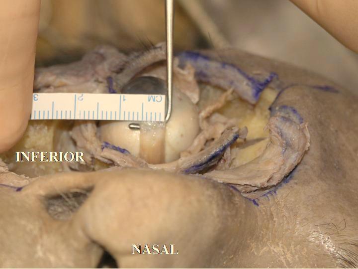 The insertion of the inferior rectus muscle tendon is usually located 6.5 mm from the inferior corneal limbus. Fig. (4-4).
