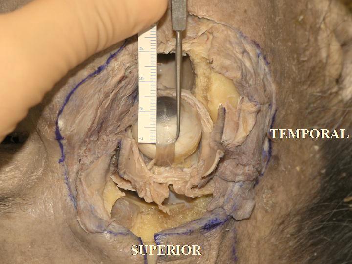 The insertion width of the superior rectus muscle tendon is lightly laterally slanted to the limbus. The width is about 7.0 mm in this specimen.