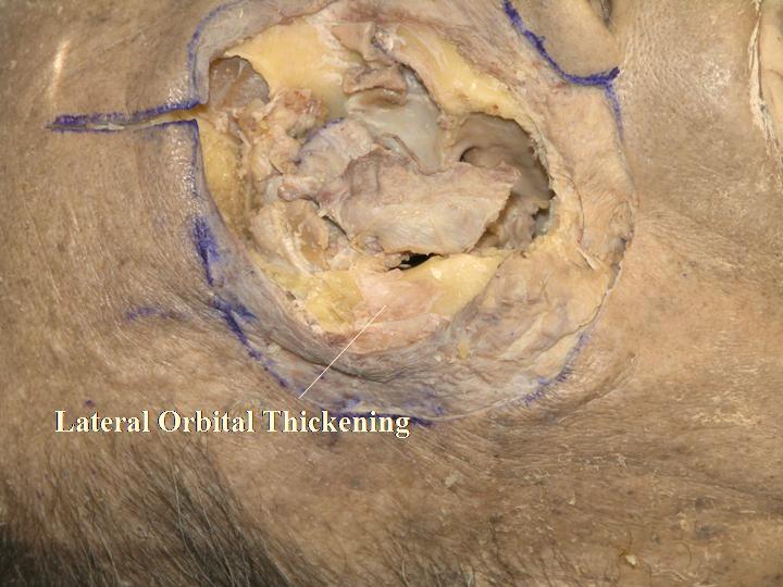 22 The Open Anatomy Journal, 2010, Volume 2 Kakizaki et al. Fig. (4-21). The thickened fibrous tissue on the bone is called the lateral orbital thickening". Fig. (4-24).