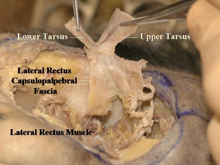 Detailed Anatomy & Clinical Hint: The lateral retinaculum is a supporting structure of the lateral canthus [25].