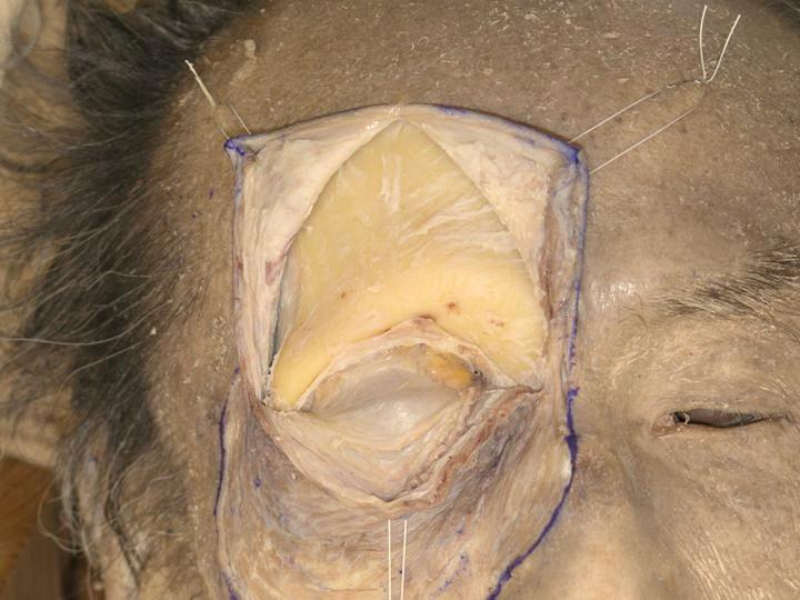 E. At this stage it is still difficult to identify the course of the levator palpebrae superioris (LPS) muscle, therefore part of the frontal bone should be removed.