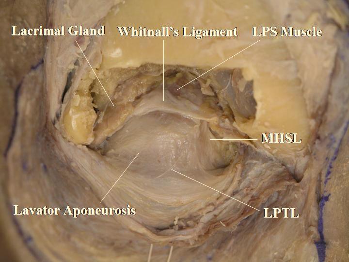 LPTL: lower positioned transverse ligament, MHSL: medial horn supporting ligament.