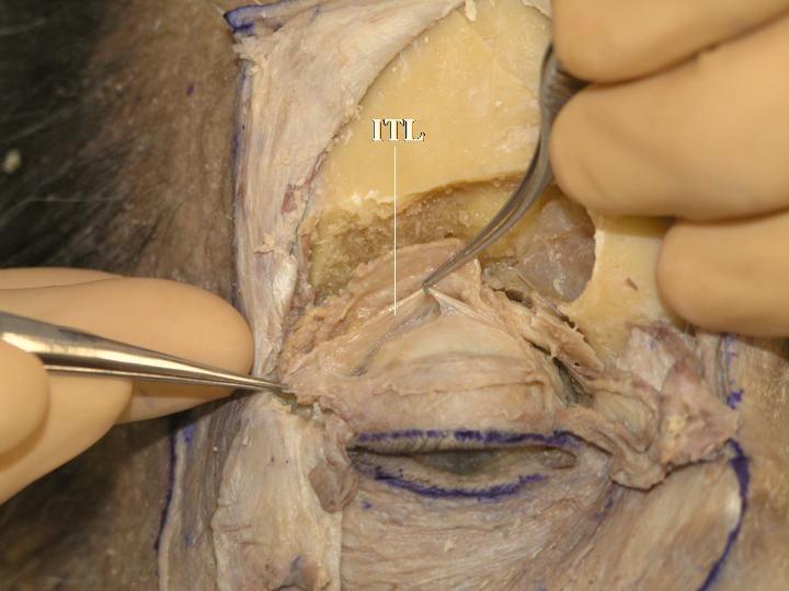 Müller s muscle is detached from the conjunctiva (Fig. 2-23). Fig. (2-24).