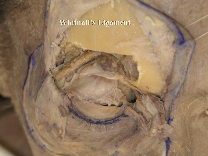 The intermuscular transverse ligament (ITL) is shown to pass under the palpebral lobe of the lacrimal gland.