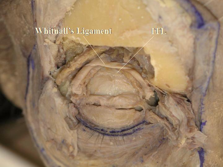 The ITL reaches the lateral orbital wall (Whitnall s tubercle) (Fig. 2-24). W.