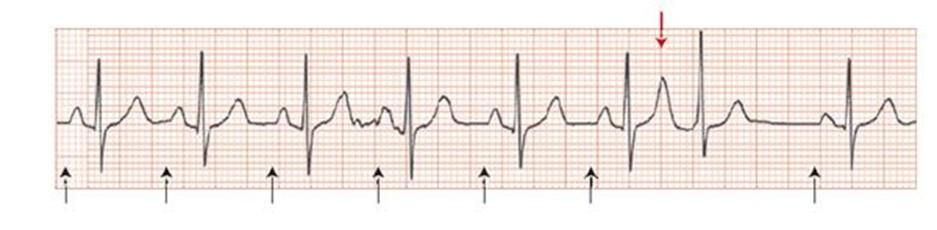 Compensatory Pause Sinus rhythm has been disturbed Compensatory pause following ectopic beat Early beat, causes heart