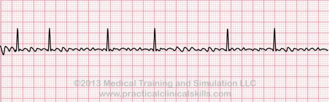 Course Atrial fibrillation Course fibrillations waves Often