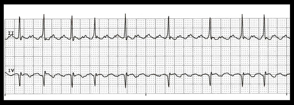 But can have variable block QRS normal