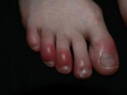 Chilblains inflammatory lesions of skin of bared body parts caused by intermittent exposure to damp, non freezing ambient temperature. Mainly in UK.