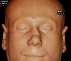 Maxillo facial trauma Fracture lines [ Extent, Comminutions, displacement ] Soft tissue injuries