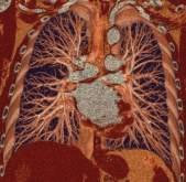 reconstructions of the pulmonary arteries to