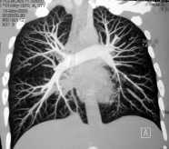 of embolism Perfusion Lung Maps Using a 4-slice CT