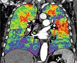 Perfusion Lung Maps Homogenous color