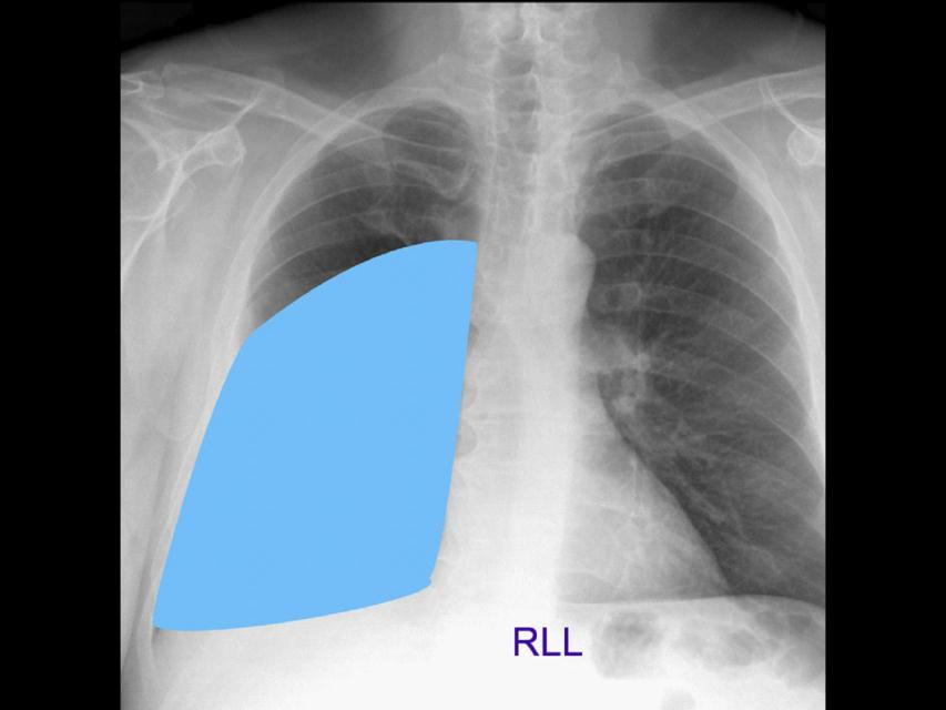 The right lower lobe is the largest of all three lobes, separated from the
