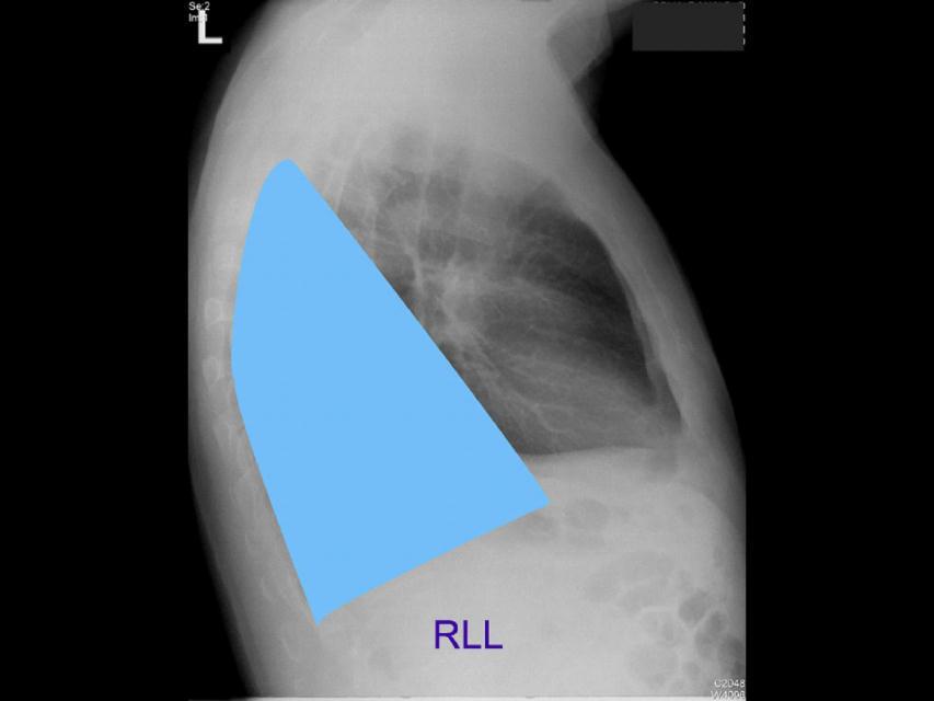 Posteriorly, the RLL extend as far superiorly as the 6th thoracic vertebral