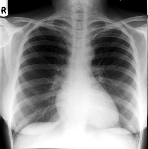 Summarise as well! "The trachea is central, the mediastinum is not displaced. The mediastinal contours and hila seem normal.