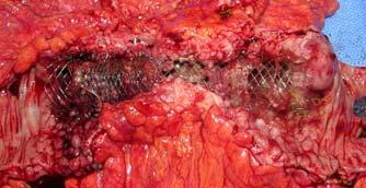 Colonic Stents All uncovered metal stents None removable Indications Malignant large bowel obstruction Malignant or presumed malignant in etiology Indeterminate strictures with clinical obstruction