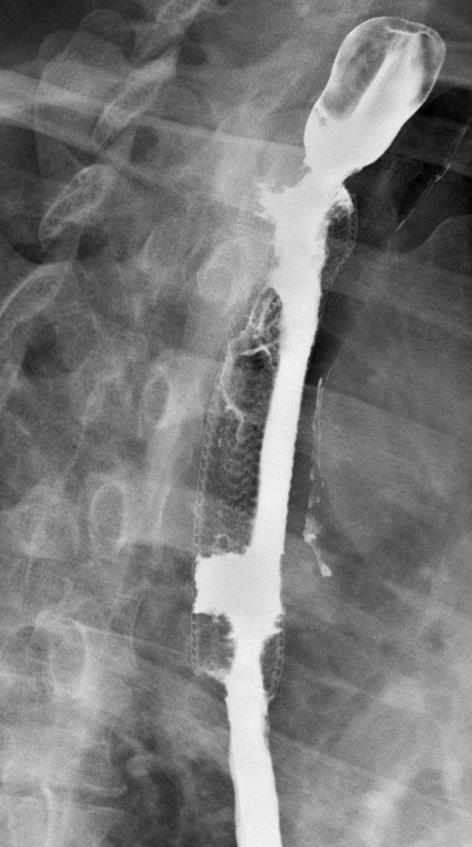 Endoscopic stent