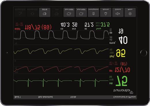 Arterial line Capnography (obstructive airways, sudden loss of