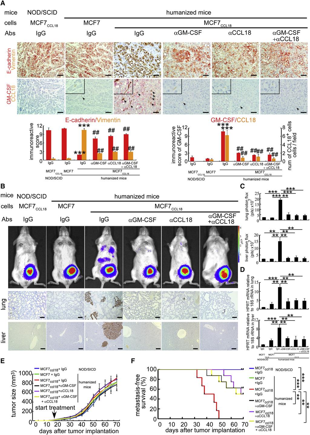 Cancer Cell GM-CSF-CCL18 Loop Promotes Breast Cancer Metastasis Figure 6.