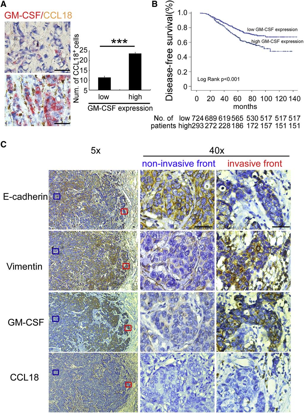 Cancer Cell GM-CSF-CCL18 Loop Promotes Breast Cancer Metastasis Figure 7.