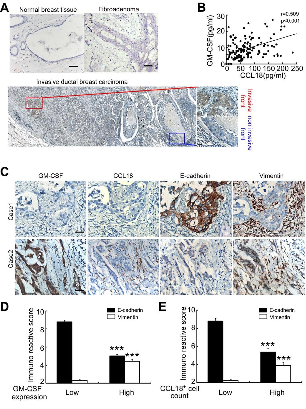 Figure S7, related to Figure 7 The GM-CSF and CCL18 loop is associated with metastasis in breast cancer patients.