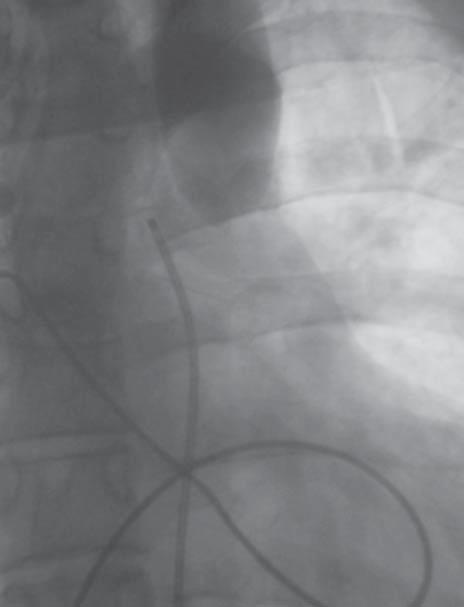 Cardiology Journal 2008, Vol. 15, No. 1 Figure 2. Aortography below the isthmus does not reveal negative contrast. Figure 4. Aortography after stent implantation. Figure 3.