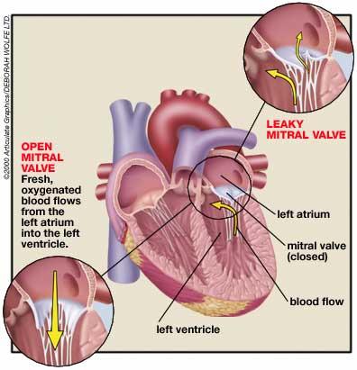Rheumatic Heart Disease: Cardiac damage resulting from a www.womensheartfoundation.