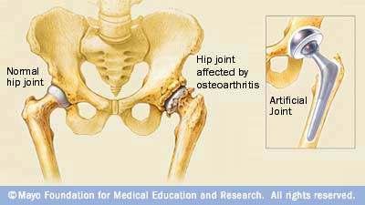 Implants: Joint replacement: -