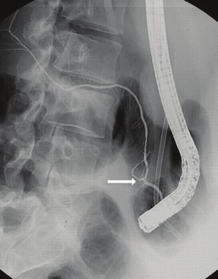 7 Petrasek J, Hucl T, Spicak J Figure 1. Endoscopic retrograde cholangiopancreatography (ERCP) showing the pancreatobiliary malunion: a. connection of both pancreatic ducts, b.