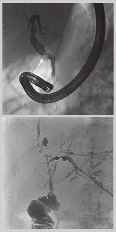Interventional biliary radiology: current state-of-the-art & future directions approach, repeated every 3 4 months for a period of 12 24 months with increasing stent diameter.