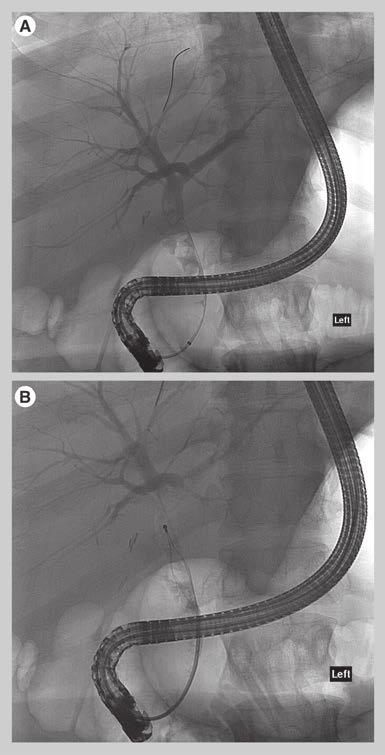 Shawyer, Goodwin & Gibson for gallbladder drainage but can also be used for additional procedures such as trans-cystic cholangiography and bile duct drainage, stone extraction and lithotripsy [2].