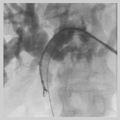 Percutaneous biliary stenting using SEMS became established in the late 1980s following the first percutaneous placement in a canine model in 1985 [12].