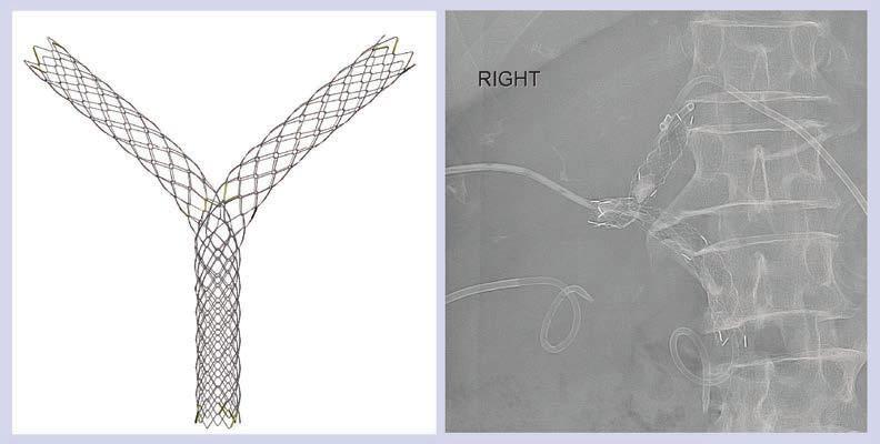 Interventional biliary radiology: current state-of-the-art & future directions Figure 9. Taewoong Large Cell Stent.