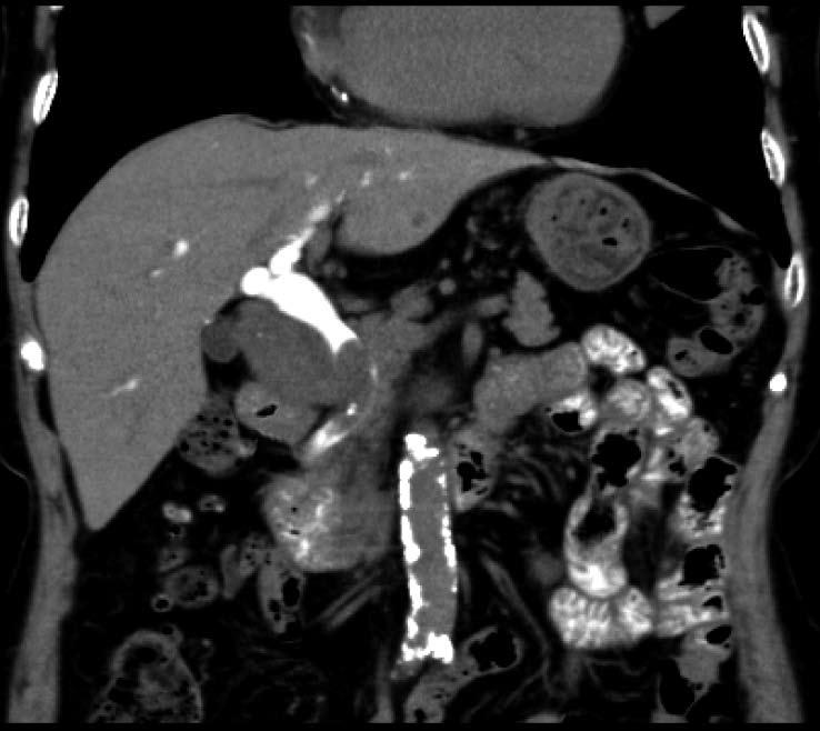 The white arrow indicates the gallbladder tumor with bile duct tumor thrombus; C: Endoscopic retrograde cholangiopancreatography image.