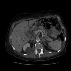 Severe intra- and extrahepatic biliary ductal dilation Pancreatic Head Mass