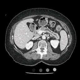 Pancreas protocol CT Pancreas