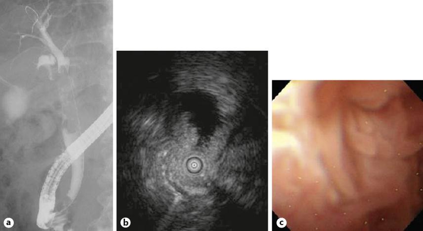421 Kawaguchi et al.: An Intraductal ry Neoplasm of the Bile Duct at the Duodenal Fig. 2.