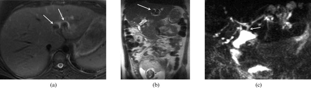 The role of MRCP in pregnant patients with acute biliary disease Figure 3. 22-year-old female at 17 weeks gestation.